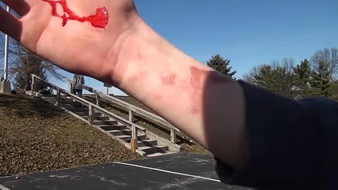 What Is The Skateboard Injury?